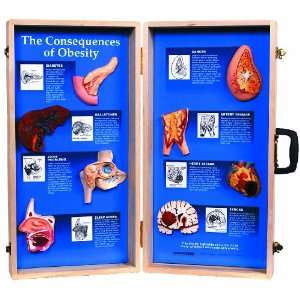   The Consequences of Obesity 3D Display, 27 Length x 28 Height Opened